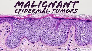 Malignant Epidermal Lesions amp Mimics 101 Carcinoma Basics  Dermatopathology Dermatology Pathology [upl. by Rees818]