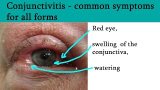 Red or pink eye  Conjunctivitis symptoms and treatment [upl. by Nodnarg]