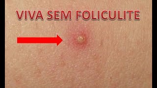 Foliculite Como Evitar [upl. by Mabelle]