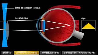 Troubles de la vision myopie et hypermétropie [upl. by Esina]