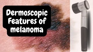 Melanoma Dermoscopy Top Signs You Should NEVER Ignore [upl. by Brigid]