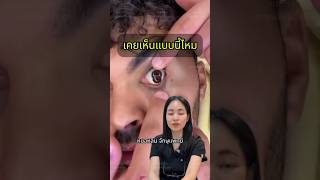 โรคตา หมอหลิน จักษุแพทย์ หมอตา สารพัดเรื่องตา ศัลยกรรมตา รู้จากtiktok tiktokuni polycoria [upl. by Lacee]