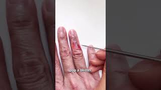 Why You Should Not Pop Blisters [upl. by Ynatsed]