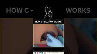 Cesarean Section Explained Why Doctors Choose CSections for a Safer Birth 👶✂️ Cesarean Birth [upl. by Yenobe]