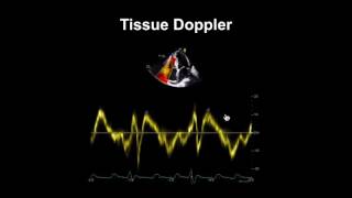 Echocardiography Essentials Evaluating right ventricular size and function [upl. by Nij]