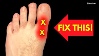 How to Fix BIG TOE Pain for Good [upl. by Alegnaoj]