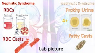 How to Solve Nephritic vs Nephrotic Syndrome questions with AMBOSS 5 hammers [upl. by Ddet]