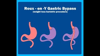 Roux en  Y Gastric bypass Animation  WLS Animation  Gastric bypass  Dr Tulip JP Nagar [upl. by Olfe]