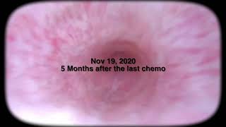 Cystoscopy into the Bladder 6 months after Chemo Nov 2020 [upl. by Edelstein]