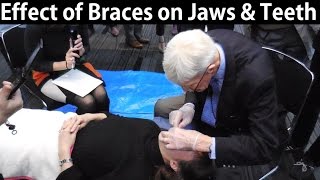 How Do Orthodontic Braces Change Upper amp Lower Jaws Position amp Teeth Misalignment by Prof John Mew [upl. by Nylednarb]