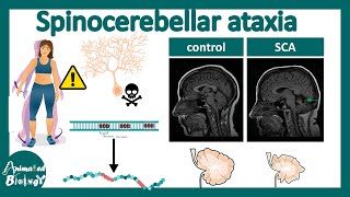 Spinocerebellar Ataxia  Pathology diagnosis and treatment of Spinocerebellar Ataxia  USMLE [upl. by Anul226]