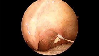 Tonsil stone removal [upl. by Ellennahc390]