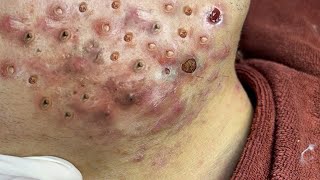 Big Cystic Acne Blackheads Extraction Blackheads amp Milia Whiteheads Removal Pimple Popping  3791 [upl. by Maegan]