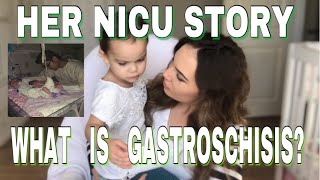 Gastroschisis l My Baby’s Survival Story l NICU Baby [upl. by Anetta]