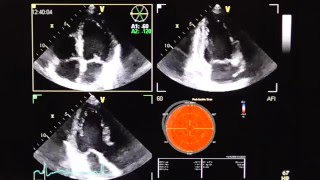 3D speckle tracking Echokardiographie 3 D speckle tracking imaging STI [upl. by Gristede]