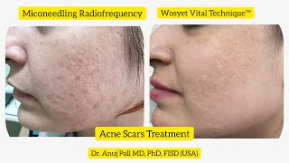 Acne scars treatment with Microneedling Radiofrequency  Subcision  Wosyet Vital Technique™ [upl. by Mossman641]