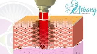 How laser treat melasma [upl. by Ahsahtan]