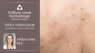 How to spot Tinea Versicolor a common fungal rash [upl. by Lenee]