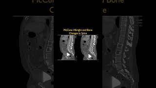 McCune Albright and Bone Changes in Spine [upl. by Massie]