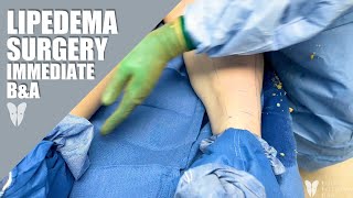 Lipedema Reduction Surgery  Immediate Before amp After  Total Lipedema Care [upl. by Leoj]