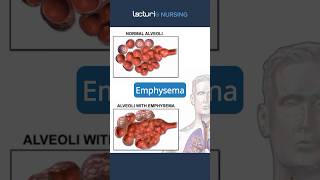 Exploring Emphysema 🔍 Emphysema RespiratoryCare nclexrn [upl. by Asiret45]