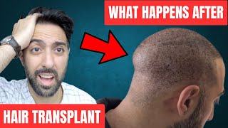 6 Struggles after a Hair Transplant what to expect [upl. by Okia]