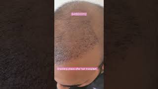 Shedding phase after hair transplant Dr Navdeep Goyal hair transplant clinic 9416500112 [upl. by Prasad]