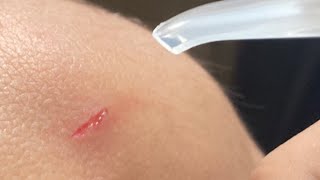 Putting hand sanitizer in a cut [upl. by Adnofal]