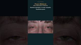 Ptosis Causes of bilateral ptosis osce practicalmedicine diagnosis [upl. by An]