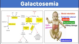 Galactosemia And Galactose Metabolism  Galactosemia Biochemistry [upl. by Akcemat]