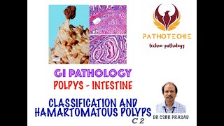 Intestinal Polyps  Classification and Hamartomatous Polyps [upl. by Nahamas]