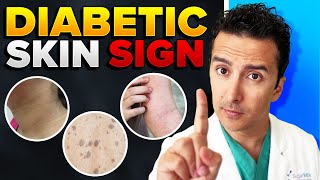 Your Skin Can Be Devastated By Diabetes [upl. by Enovad250]