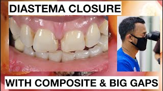 Step by Step Diastema Closure Composite with Big Gaps  General Dentist Griya RR [upl. by Ryan]