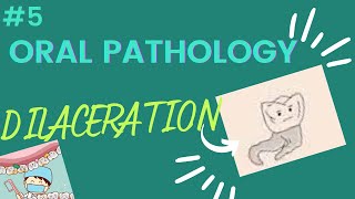 DILACERATION in dentistry [upl. by Siuoleoj]