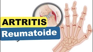 ARTRITIS REUMATOIDE  Síntomas Diagnóstico Tratamiento [upl. by Anaela]