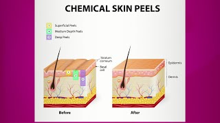 Chemical Peel Purpose amp Types [upl. by Asyl]