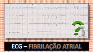 ECG  Eletrocardiograma com Fibrilação Atrial e Alta Resposta Ventricular [upl. by Vanden]