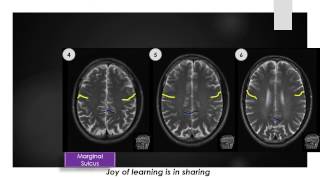 MRI Anatomy cut 45 amp 6 [upl. by Etnor]