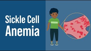 Sickle Cell Anemia [upl. by Elehcim]