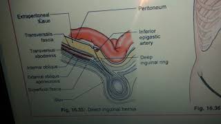 Inguinal Hernia  Anatomy in easy way [upl. by Lilybel]