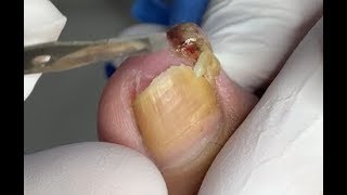 A toenail with polypus on toenail top [upl. by Sumerlin]