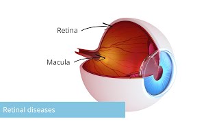 Retinal diseases Causes symptoms diagnosis amp treatment Essentials in 3 minutes Eye surgery [upl. by Eisnyl]