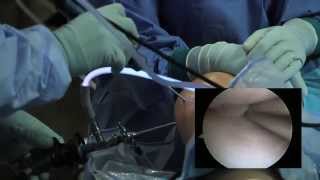 Arthroscopic Knee Surgery Meniscus Tear [upl. by Lovash]