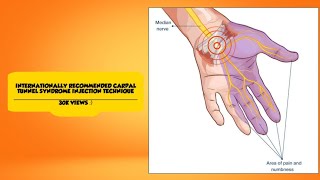 Injection technique for Carpal tunnel syndrome [upl. by Jahdiel]