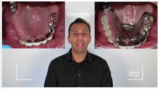 Options to replace missing teeth Partial Dentures [upl. by Haduhey]