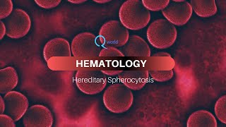 Hereditary Spherocytosis Hematology tutorials for NEETPG USMLE and MBBS [upl. by Eolcin379]