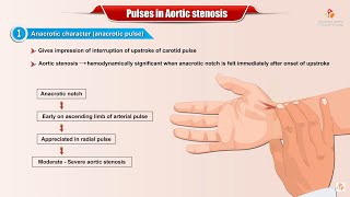 PULSES IN AORTIC STENOSIS  Usmle Cardiology [upl. by Rivkah]