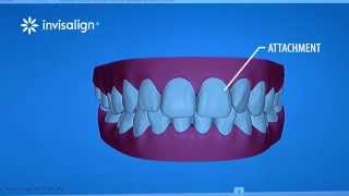 What You Can Expect During Invisalign Treatment [upl. by Leroj120]