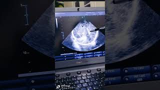 cranial ultrasound multiple choroid plexus cysts [upl. by Ivers]