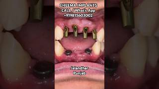 Teeth implants cost front upper lower incisor Jalandhar dentist Gap in teeth dentalimplant dental [upl. by Eyahc29]